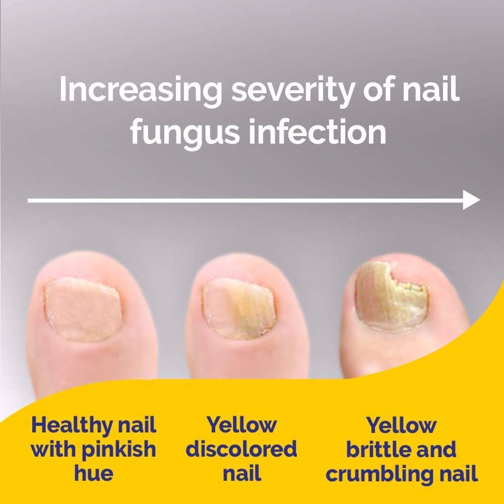 Schollmed Fungal Nail Treatment 5% - 2.5ml